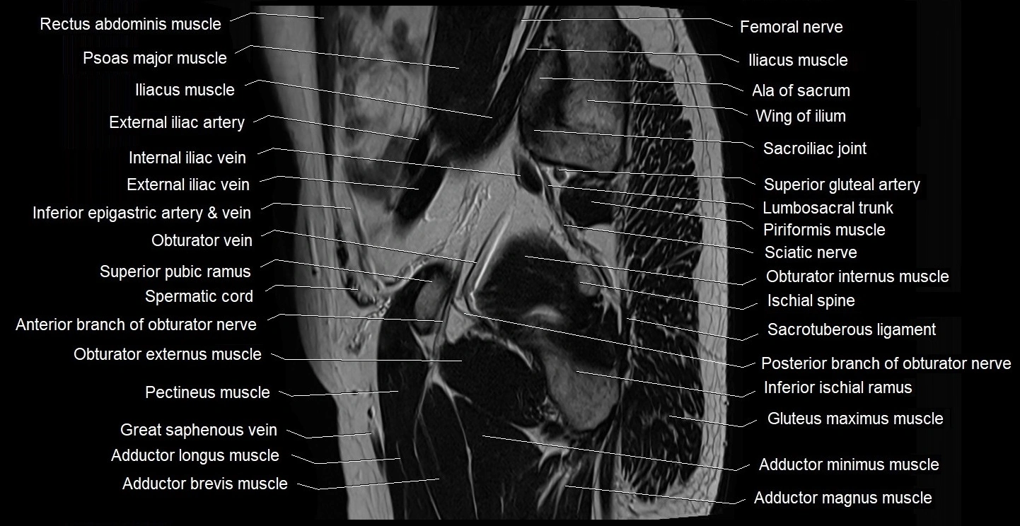 male pelvis sagittal cross sectional anatomy 3T mri image 38.webp